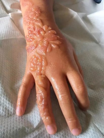 Niestety po tymczasowym tatuażu z henny zostały bolesne pęcherze i blizny.