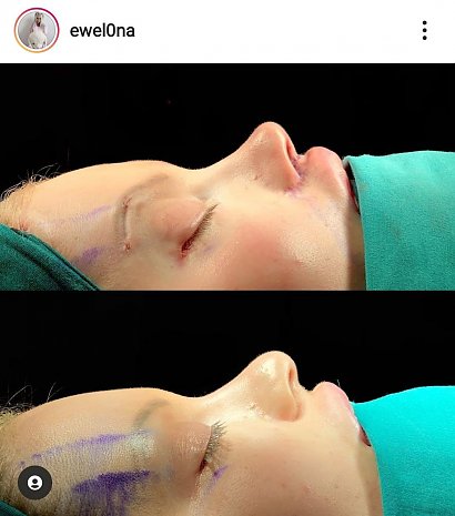 Ewelina Kubiak przed i po operacji nosa