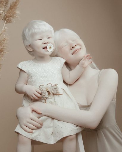 Siostry z albinizmem zachwyciły nietypową urodą!