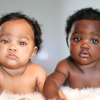 Dziewczynki urodziły się z różnymi kolorami skóry!