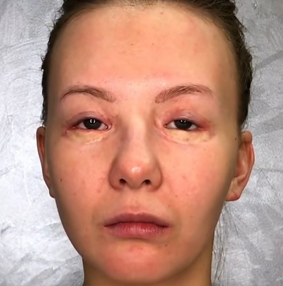 Zobacz szokującą metamorfozę kobiety, której liczne operacje oczu zdeformowały powieki.
