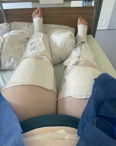 Kinga Zawodnik w dniu operacji z obandażowanymi nogami...